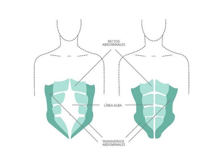 Diastasis abdominal: qué es, como prevenirla y solucionarla